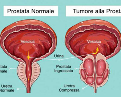 Salute & Benessere. Tumore alla prostata: addio bisturi e radioterapia per quelli a basso rischio